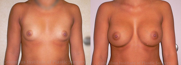 Breast Augmentation – 400cc-500cc before and after photo by Columbus Institute of Plastic Surgery in Columbus, OH