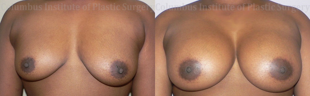 Breast Augmentation before and after photo by Columbus Institute of Plastic Surgery in Columbus, OH