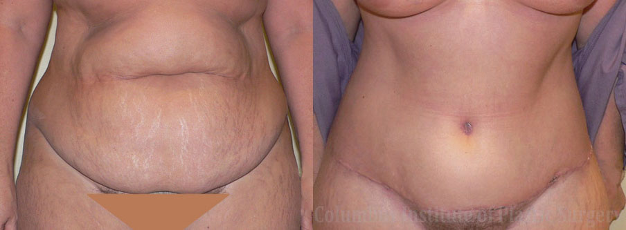 Abdominoplasty (Tummy Tuck) before and after photo by Columbus Institute of Plastic Surgery in Columbus, OH
