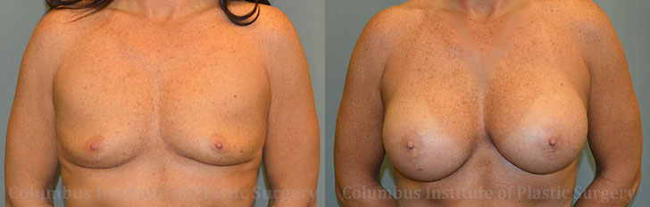 Breast Augmentation before and after photo by Columbus Institute of Plastic Surgery in Columbus, OH