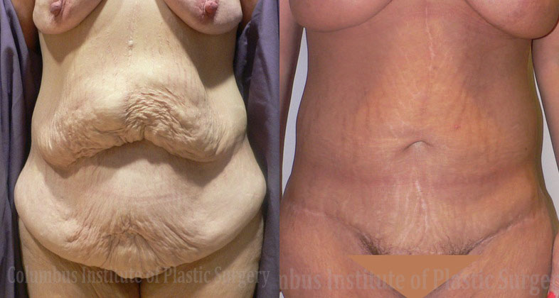 Abdominoplasty after Weight Loss before and after photo by Columbus Institute of Plastic Surgery in Columbus, OH