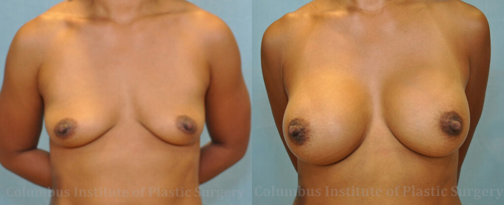 Breast Augmentation – 300cc-400cc before and after photo by Columbus Institute of Plastic Surgery in Columbus, OH