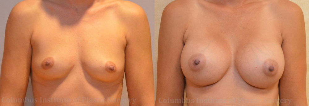 Breast Augmentation – 400cc-500cc before and after photo by Columbus Institute of Plastic Surgery in Columbus, OH