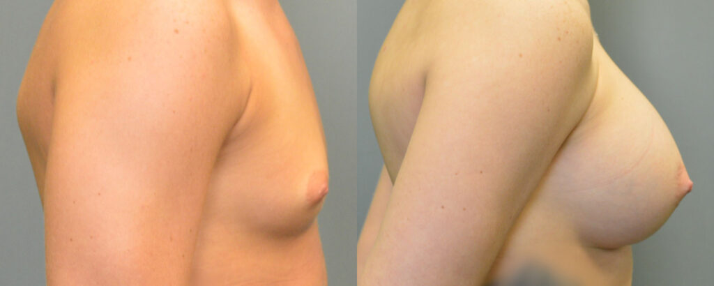Breast Augmentation before and after photo by Columbus Institute of Plastic Surgery in Columbus, OH