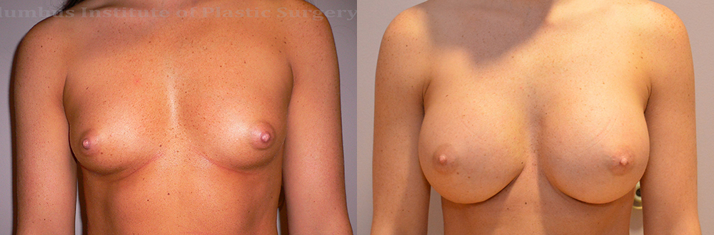 Breast Augmentation – 400cc-500cc before and after photo by Columbus Institute of Plastic Surgery in Columbus, OH