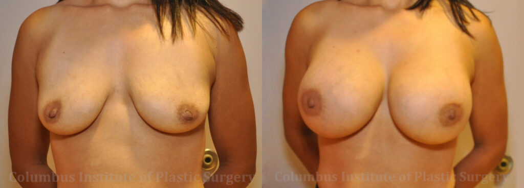 Breast Augmentation before and after photo by Columbus Institute of Plastic Surgery in Columbus, OH
