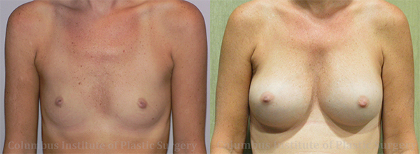 Breast Augmentation before and after photo by Columbus Institute of Plastic Surgery in Columbus, OH