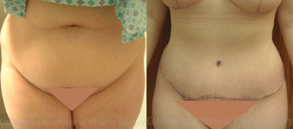 Abdominoplasty (Tummy Tuck) before and after photo by Columbus Institute of Plastic Surgery in Columbus, OH