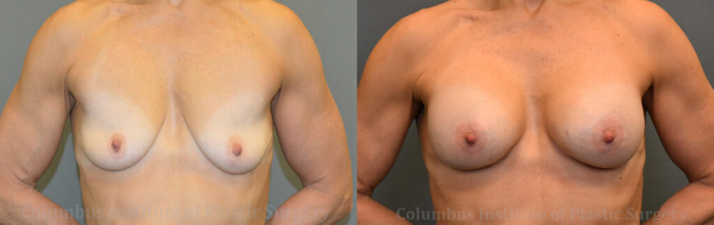 Breast Augmentation before and after photo by Columbus Institute of Plastic Surgery in Columbus, OH