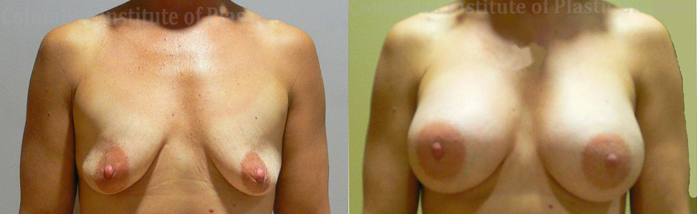 Breast Augmentation before and after photo by Columbus Institute of Plastic Surgery in Columbus, OH