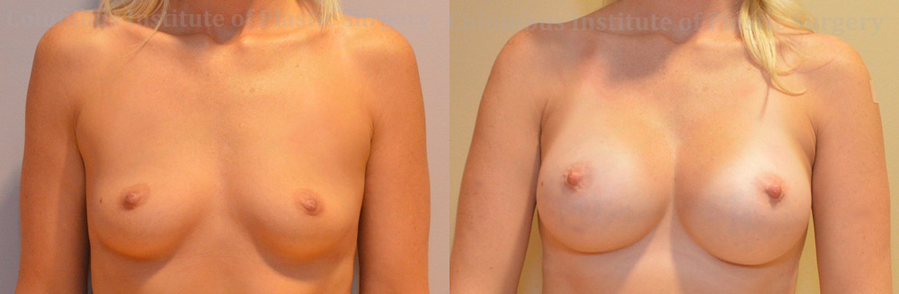 Breast Augmentation – 400cc-500cc before and after photo by Columbus Institute of Plastic Surgery in Columbus, OH
