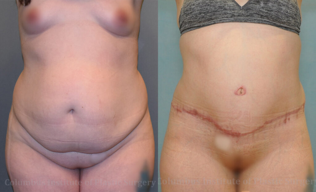 Abdominoplasty (Tummy Tuck) before and after photo by Columbus Institute of Plastic Surgery in Columbus, OH