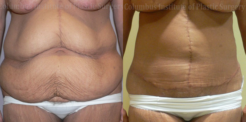 Abdominoplasty after Weight Loss before and after photo by Columbus Institute of Plastic Surgery in Columbus, OH