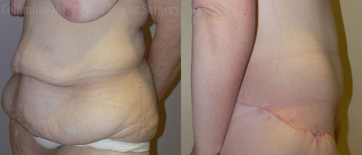 Belt Lipectomy before and after photo by Columbus Institute of Plastic Surgery in Columbus, OH