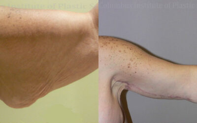 Brachioplasty (Arm Lift) before and after photo by Columbus Institute of Plastic Surgery in Columbus, OH Brachioplasty (Arm Lift) before and after photo by Columbus Institute of Plastic Surgery in Columbus, OH