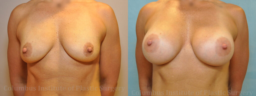 Breast Augmentation – 300cc-400cc before and after photo by Columbus Institute of Plastic Surgery in Columbus, OH