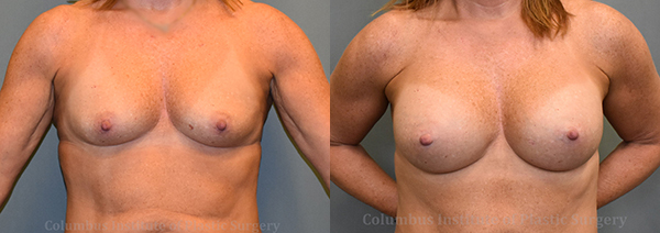 Breast Augmentation – 400cc-500cc before and after photo by Columbus Institute of Plastic Surgery in Columbus, OH