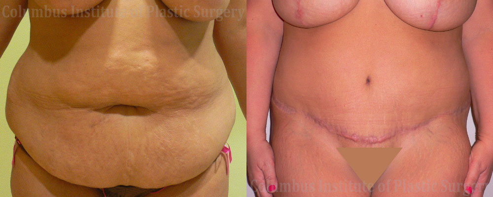 Abdominoplasty (Tummy Tuck) before and after photo by Columbus Institute of Plastic Surgery in Columbus, OH