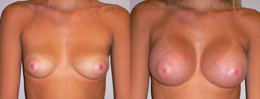 Breast Augmentation before and after photo by Columbus Institute of Plastic Surgery in Columbus, OH
