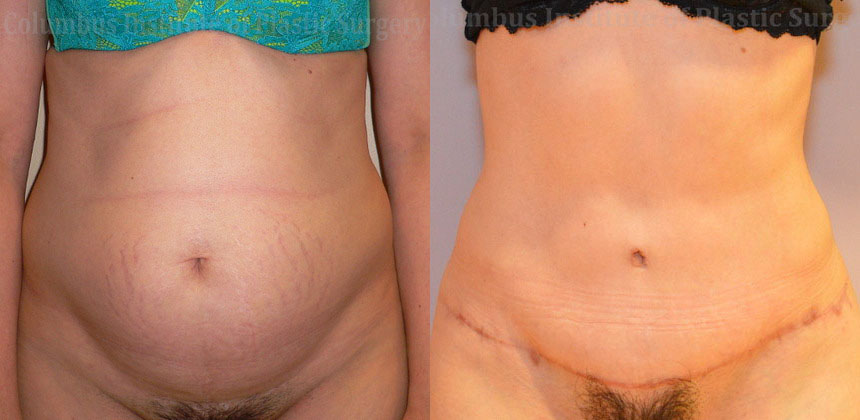 Abdominoplasty (Tummy Tuck) before and after photo by Columbus Institute of Plastic Surgery in Columbus, OH