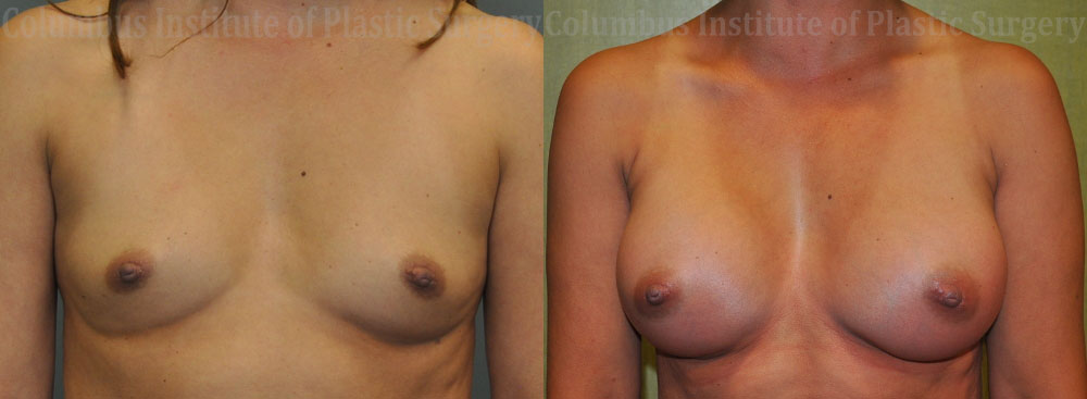 Breast Augmentation before and after photo by Columbus Institute of Plastic Surgery in Columbus, OH