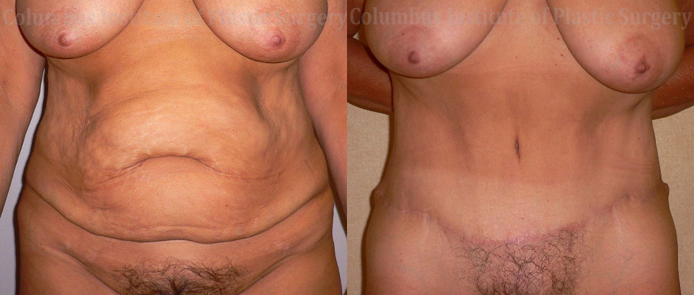 Abdominoplasty (Tummy Tuck) before and after photo by Columbus Institute of Plastic Surgery in Columbus, OH