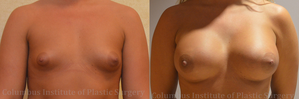 Breast Augmentation before and after photo by Columbus Institute of Plastic Surgery in Columbus, OH