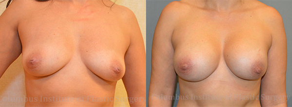 Breast Augmentation before and after photo by Columbus Institute of Plastic Surgery in Columbus, OH