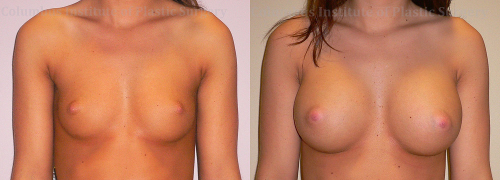 Breast Augmentation – 400cc-500cc before and after photo by Columbus Institute of Plastic Surgery in Columbus, OH
