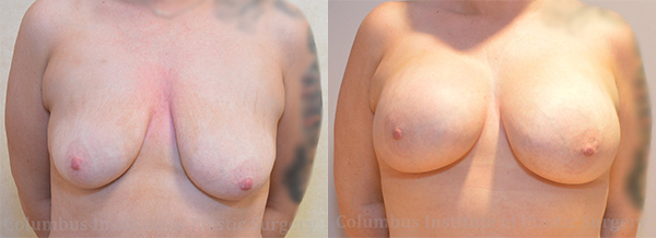 Breast Augmentation before and after photo by Columbus Institute of Plastic Surgery in Columbus, OH