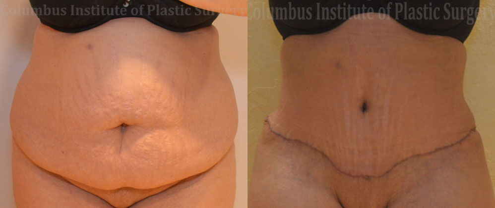 Abdominoplasty (Tummy Tuck) before and after photo by Columbus Institute of Plastic Surgery in Columbus, OH
