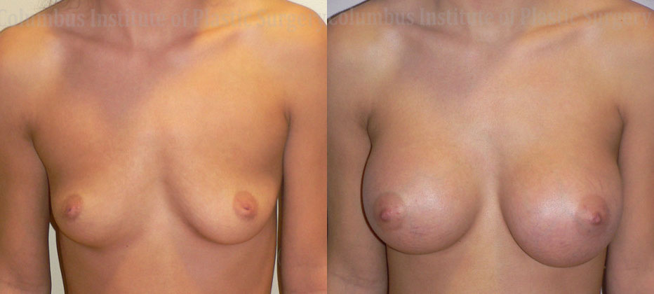 Breast Augmentation before and after photo by Columbus Institute of Plastic Surgery in Columbus, OH