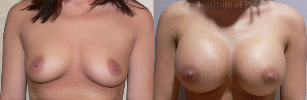 Breast Augmentation – 400cc-500cc before and after photo by Columbus Institute of Plastic Surgery in Columbus, OH