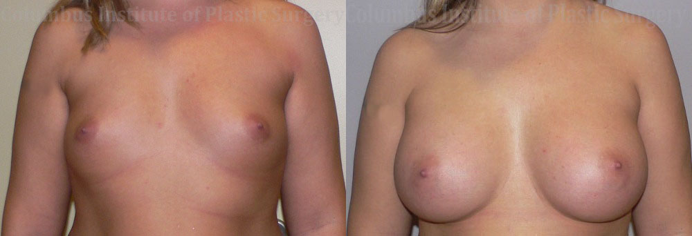 Breast Augmentation – 400cc-500cc before and after photo by Columbus Institute of Plastic Surgery in Columbus, OH