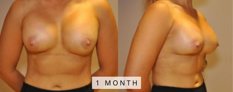 Breast Augmentation Before and After Results month