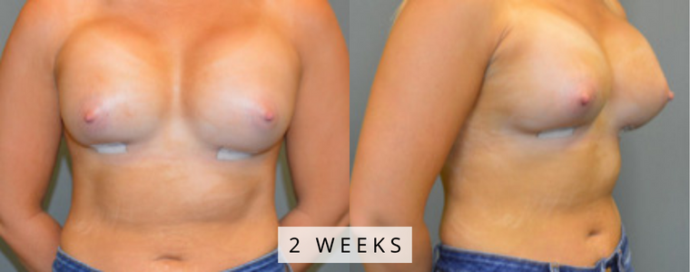 Breast Augmentation Before and After Results weeks