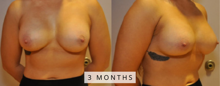 Breast Augmentation Before and After Results months