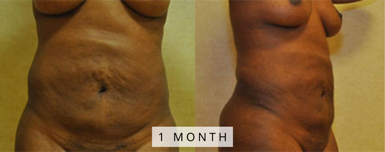 Liposuction Before and After Results mo