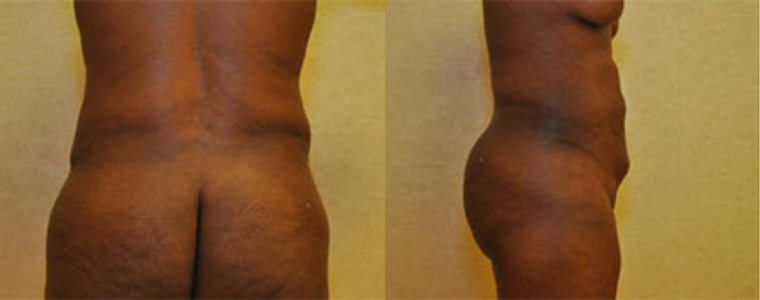 Liposuction Before and After Results mo