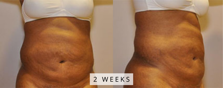 Liposuction Before and After Results wks