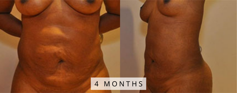 Liposuction Before and After Results mo