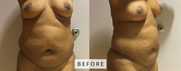 Liposuction Before and After Results before