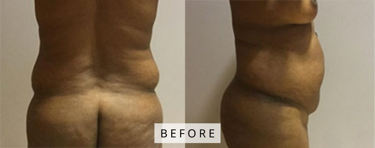 Liposuction Before and After Results before
