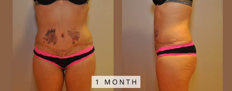 Tummy Tuck Before and After Results month