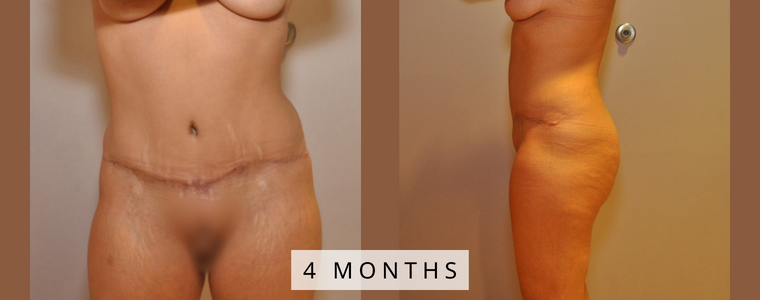 Tummy Tuck Before and After Results months