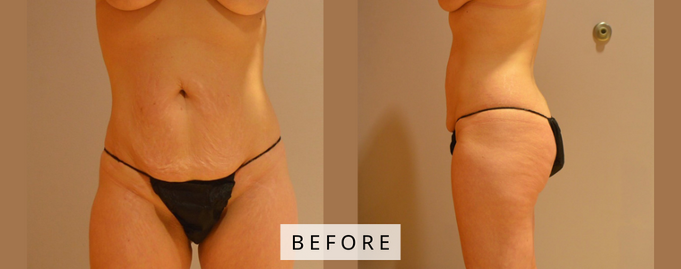 Tummy Tuck Before and After Results before
