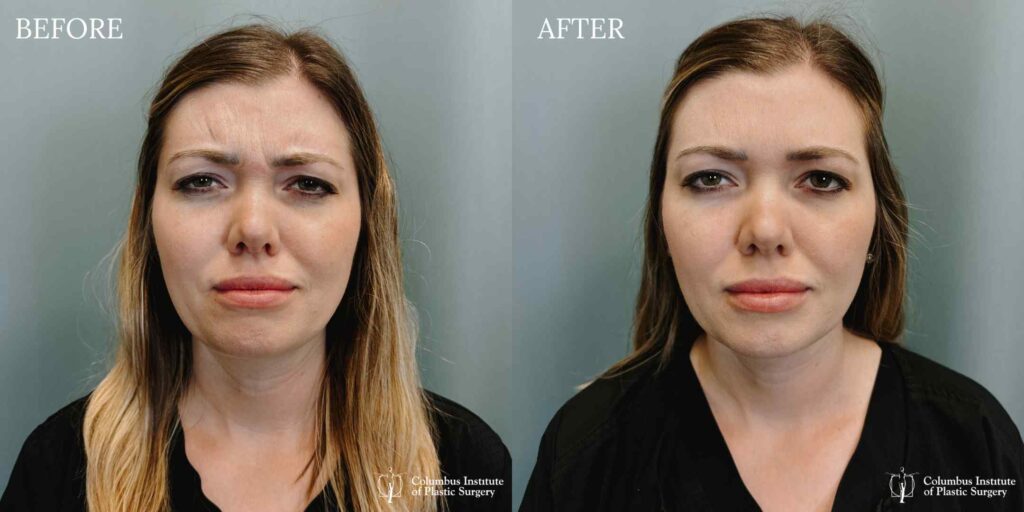 Fillers and Botox before and after photo by Columbus Institute of Plastic Surgery in Columbus OH