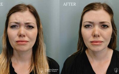 Fillers and Botox before and after photo by Columbus Institute of Plastic Surgery in Columbus OH Fillers and Botox before and after photo by Columbus Institute of Plastic Surgery in Columbus OH