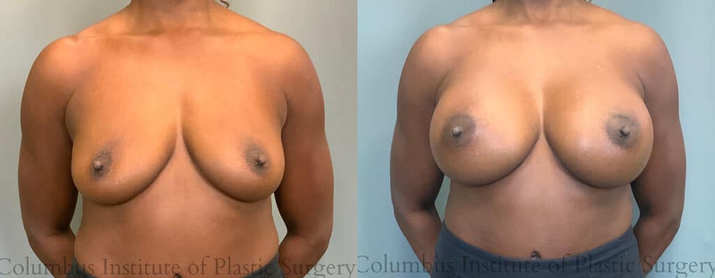 Breast Augmentation before and after photo by Institute of Plastic Surgery in Columbus OH