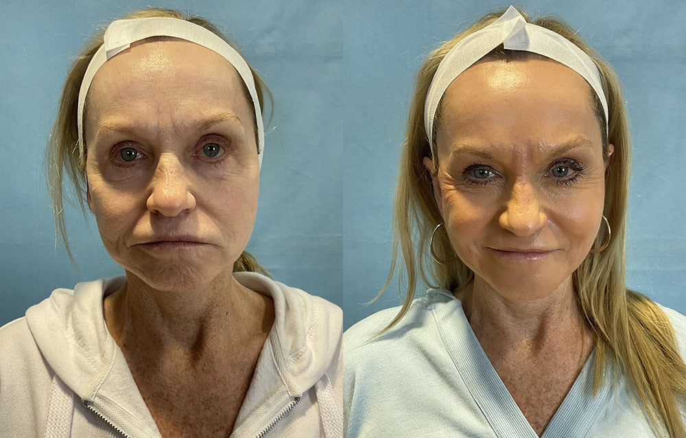 Phenol Peel before and after photo by Columbus Institute of Plastic Surgery in Columbus OH
